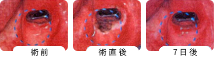 歯肉切除